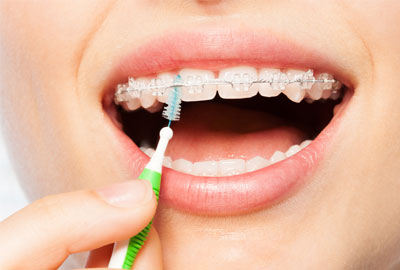 All you need to know about clear ceramic braces – Somos Dental