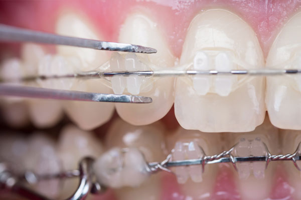 All you need to know about clear ceramic braces – Somos Dental