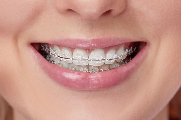 clear ceramic braces in chevy chase md