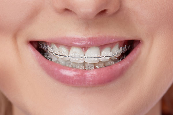 Clear Ceramic Braces in Chevy Chase MD