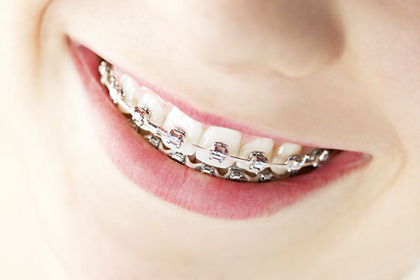 silver braces in chevy chase md
