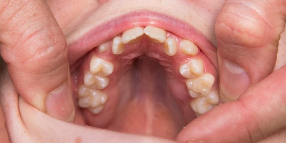 Why Should I Care About Straight Teeth_ care about straight teeth