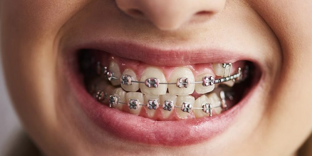 how-braces-move-teeth-today